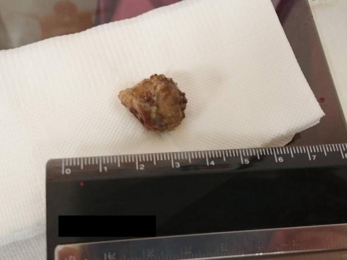 「隕石級」扁桃腺結石　卡氣管險致命
