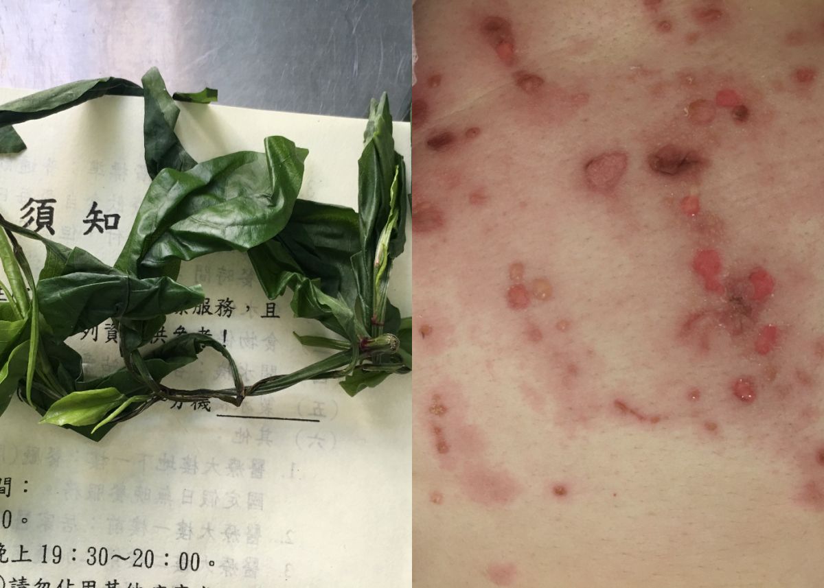 ▲婦人自行敷草藥導致後頸又黑又腫。（圖／彰化醫院提供）