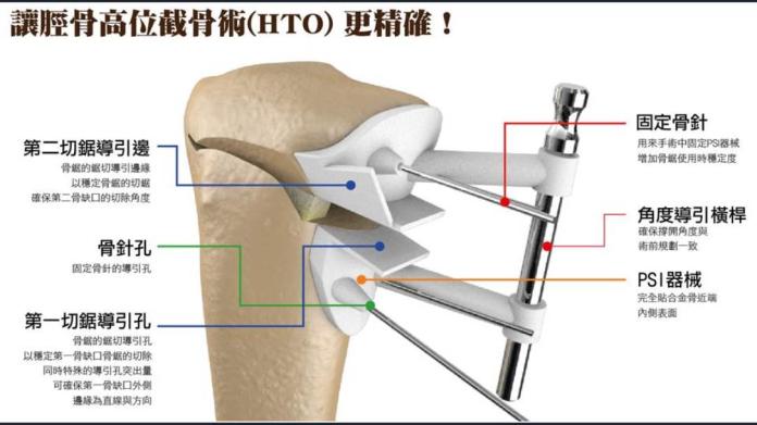 ▲3D列印技術導入「高位脛骨矯正保膝手術」(High Tibial Osteotomy,簡稱HTO)。（圖／安南醫院提供）