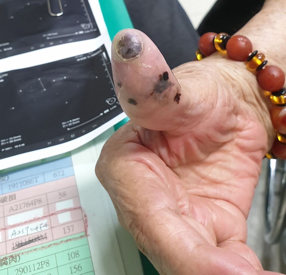 ▲阿嬤因腋下腫塊就醫，沒想到竟是黑色素瘤。（圖／彰化醫院提供）