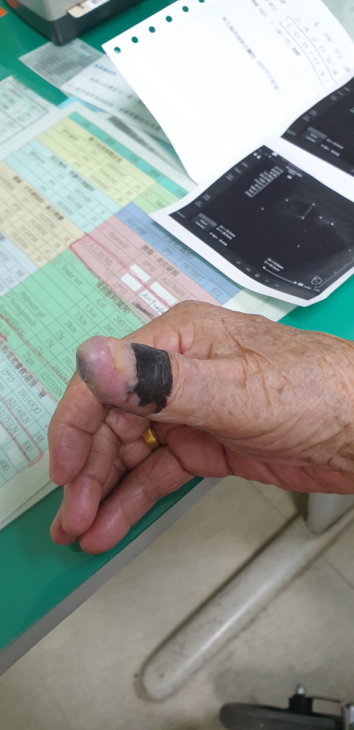 ▲施姓阿嬤右大拇指存在30年的「痣」發生癌變，彰化醫院一般外科醫師李忠懷呼籲，黑色素瘤為惡性度最高的皮膚癌，痣若發生變化就要就醫。（圖／記者陳雅芳攝，2019.05.29）