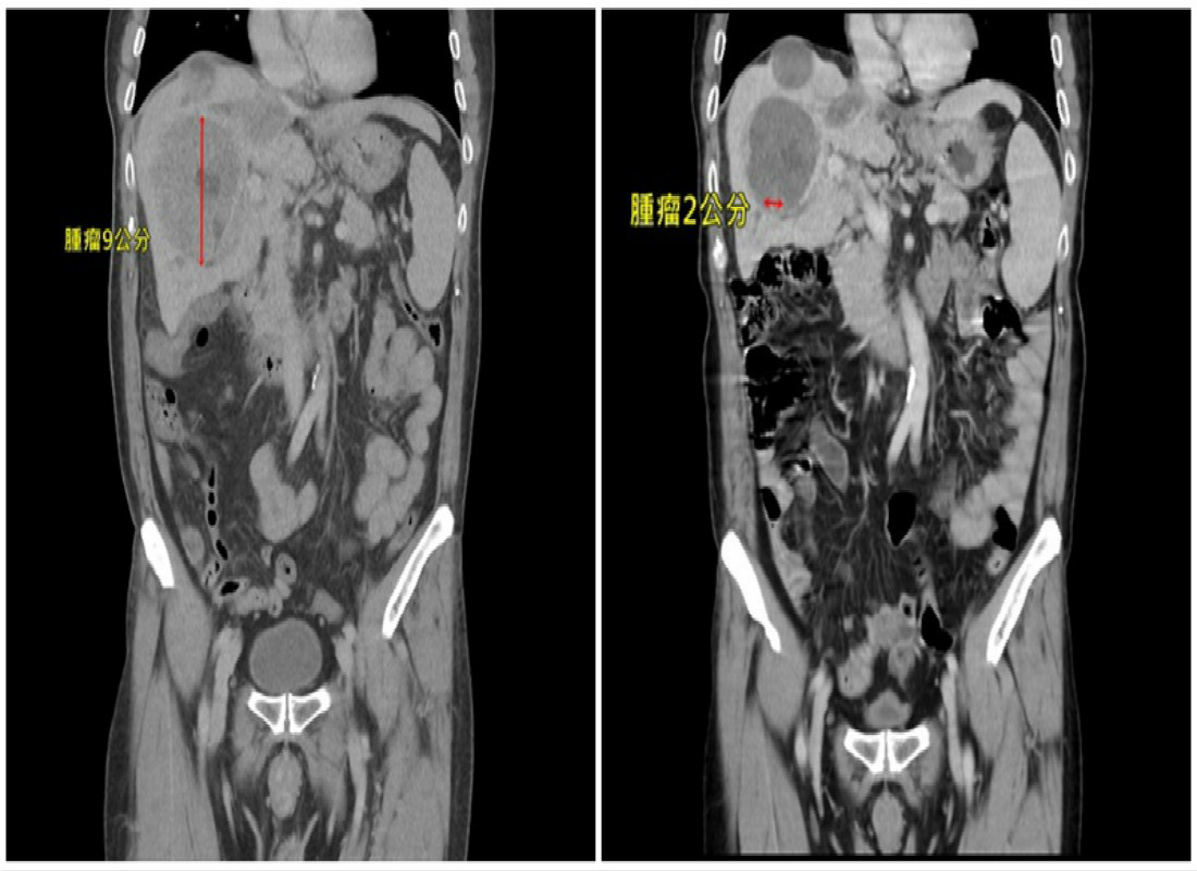 ▲莊先患有B肝，卻無定期治療，導致肝臟長了一顆腫瘤，甚至還轉移至肺部。（圖／亞大醫院提供）