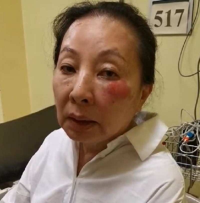 ▲嘉義縣前縣長張花冠晨運時不慎跌倒，左側臉及左膝擦傷。（圖／記者陳惲朋翻攝）