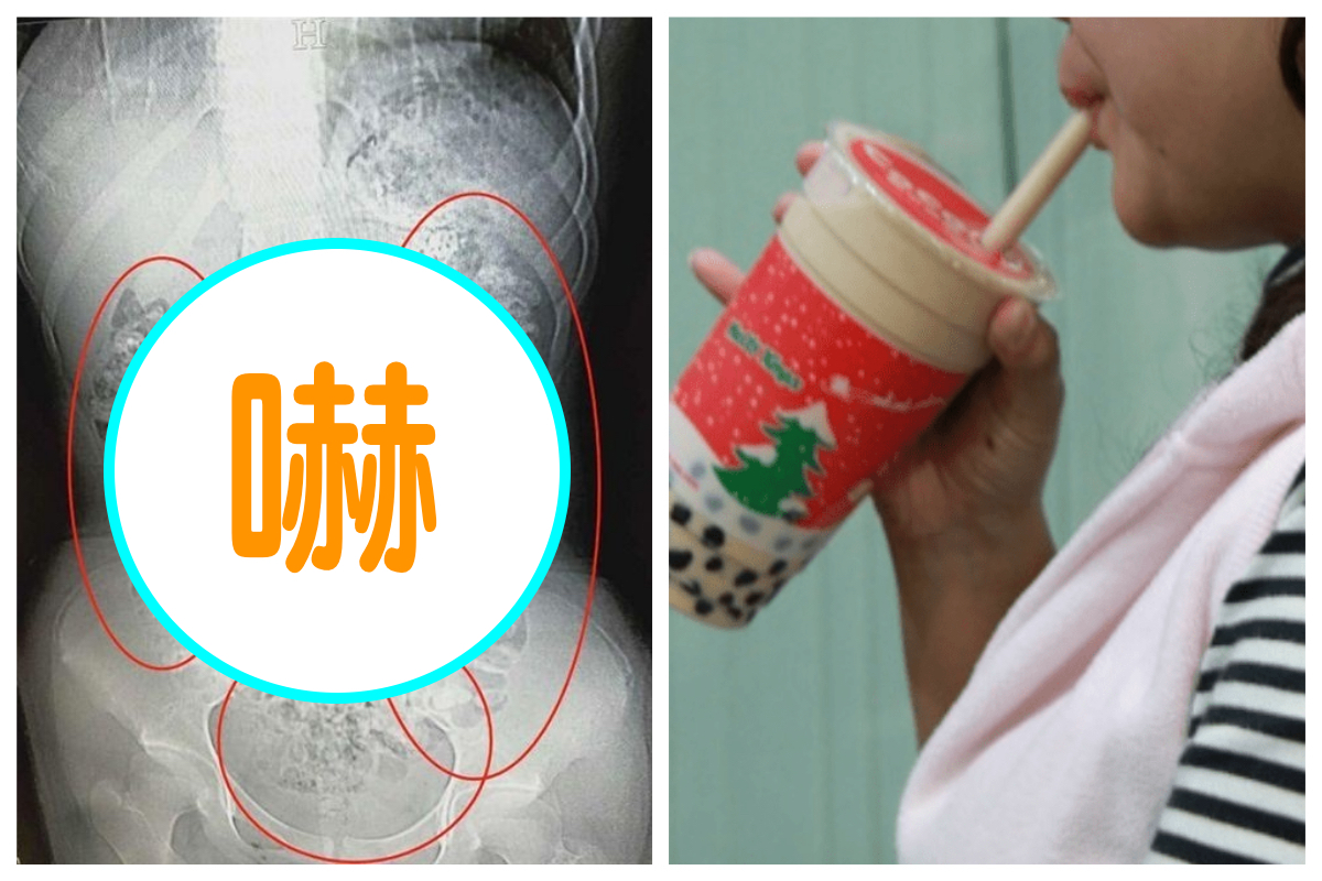 ▲少女因為腹痛到醫院照電腦斷層掃描，驚見肚子裡有上百顆「顆粒狀陰影」，讓人看了頭皮發麻。（合成圖／翻攝自浙江新聞／NOWnews 資料圖片）