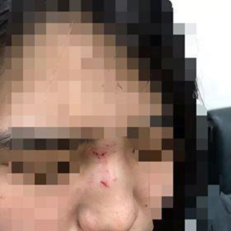 ▲被擊中臉部的妹妹，臉上還殘留有血跡（圖／被害人上公佈於爆料公社）