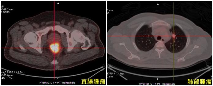 ▲病患正子電腦斷層造影影像，顯示直腸及肺部腫瘤。（圖／亞大附屬醫院提供）