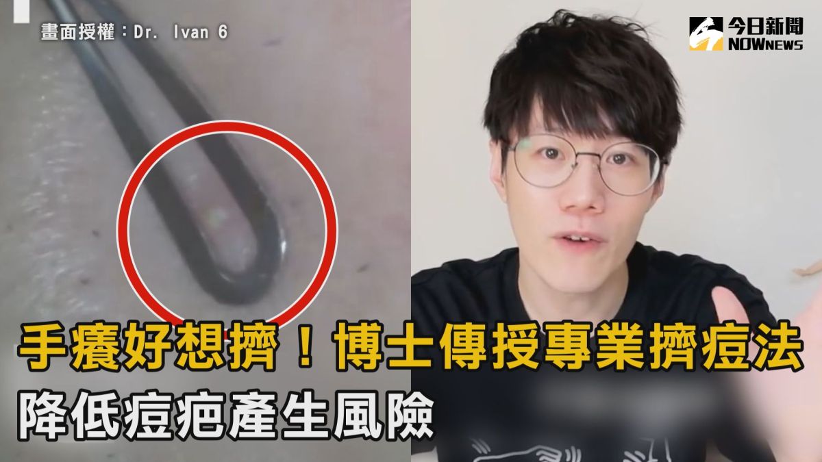 ▲ 手癢好想擠痘怎麼辦？他傳授正確擠痘方式，降低痘疤產生。（圖／Dr. Ivan 6 授權）