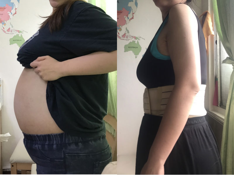 ▲女子努力減肥肚子卻瘦不下來，竟是肚子裡藏16公斤水瘤。（圖／國泰醫院提供）