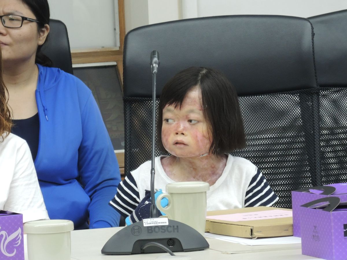 ▲今年12歲就讀芬園國小女學童張彧綺，一出生就罹患先天性表皮鬆解水皰症。（圖／記者陳雅芳攝，2019.06.12）