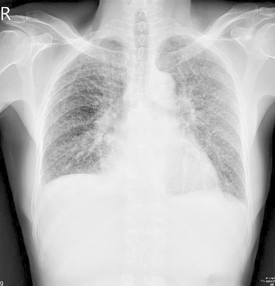 ▲經由 X 光影像，可見患者雙側肺部出現許多小白點。（圖／亞大附屬醫院提供）