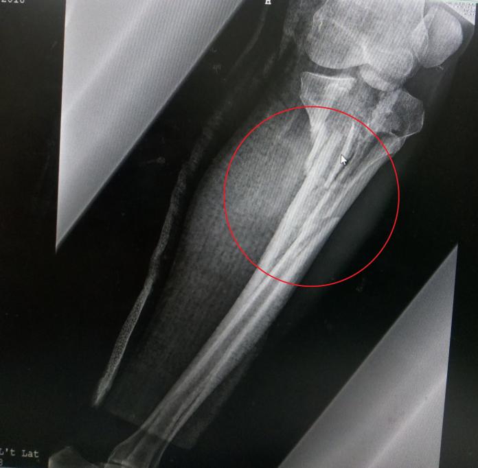 ▲陳先生因車禍造成左膝粉碎性骨折（紅圈處），並影響血液循環，差點要截肢。（圖／大千綜合醫院提供）