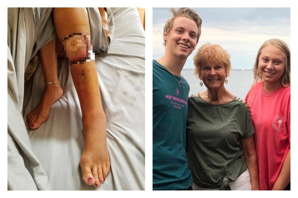 ▲「壞死性筋膜炎」讓婦人短短數日就喪命。（合成圖／取自 triblive ）