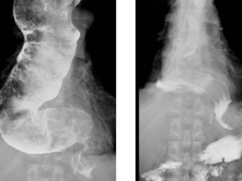 ▲男子因患食道弛緩不能症，導致食道充滿未消化的食物。（圖／北榮提供）
