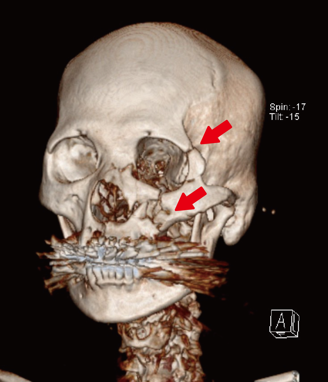 ▲女子因走路用手機跌倒，導致鐵架刺穿臉頰。（圖／馬偕醫院提供）