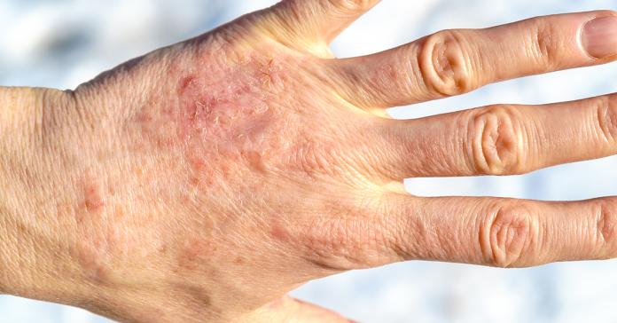 ▲乾癬是1種自體免疫異常疾病，多數患者以頭皮為最主要發作部位，嚴重時如雪花片片，其他全身部位也可能長出，特徵為界線清楚的斑塊或紅色丘疹，或附一層銀白色鱗屑。（圖／ingimage）