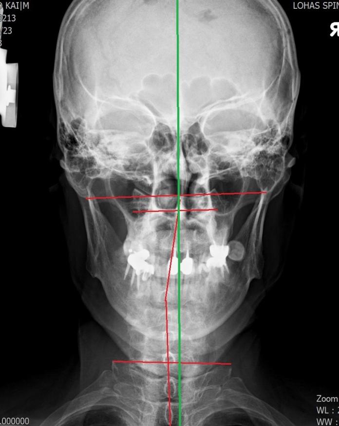 ▲ X 光影像檢查可見頸椎向左歪斜（紅線），正常排列應為垂直（綠線）。（圖／活力得中山脊椎外科醫院提供）