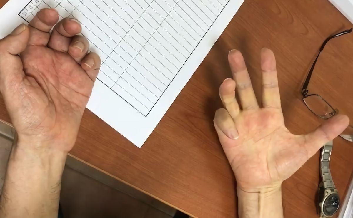 ▲中年男手抖且萎縮長達18年，穿鞋、扣鈕釦及簽名都須有人從旁協助。（圖／活力得中山脊椎外科醫院提供）