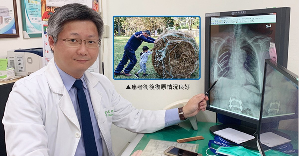 ▲公職退休的阿公，因從樓梯上摔下來導致肋骨錯位插進胸腔，造成肺臟破裂胸腔出血，經新式的肋骨骨折復位矯正鋼板內固定手術治療後，已順利出院且復原良好。謝志明指出，一般造成肋骨骨折的原因，主要有車禍、從高處墜下、走路或跑步不慎摔倒、運動傷害及重力撞擊等。（圖／謝志明醫師提供）