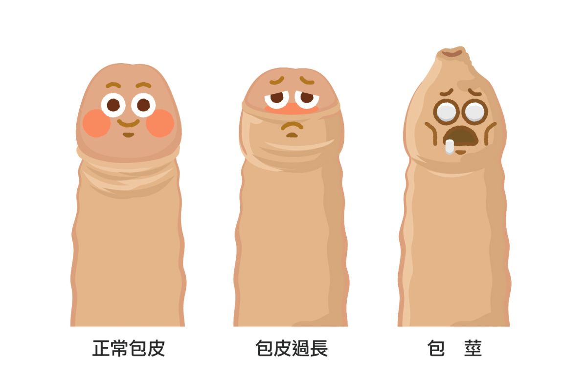 ▲男子擔憂割包皮弟弟會變小，遲遲不肯就醫。（圖／亞大醫院提供）