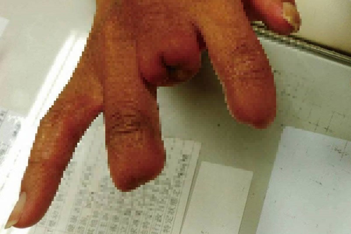 ▲因為柏格氏症，已有 2 指遭截肢。（圖／翻攝自門諾醫院臉書）