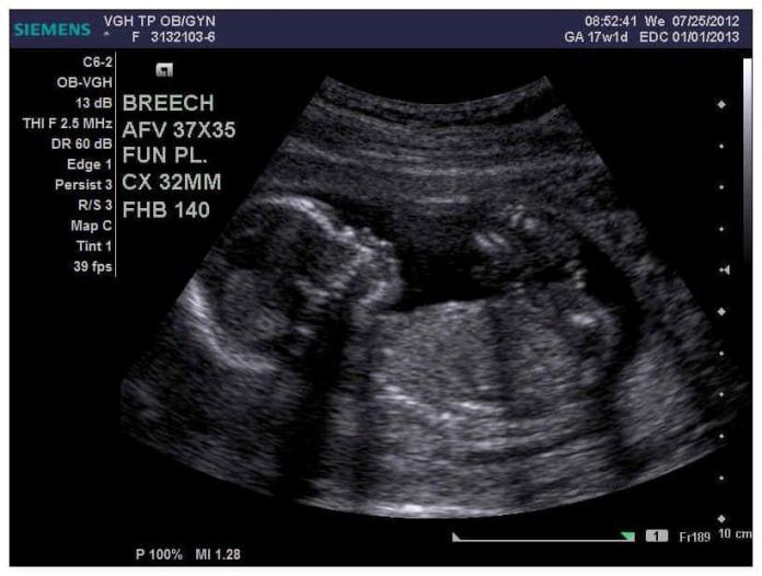 ▲有媽媽網友分享自己的 17 周照片「 17 周長這樣啦！你的超音波照片只是胚胎，怎樣都不是 17 周的寶寶，請弟弟帶女友再去婦產科驗一次啊！」。（圖／翻攝自《爆料公社》）