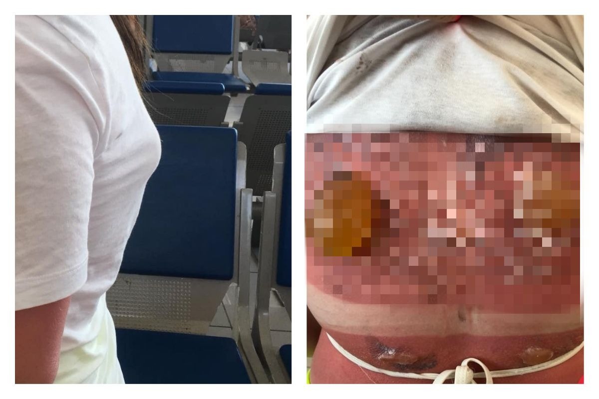 ▲一名英國少女在浮潛 1 小時候長出超巨型水泡。（合成圖／翻攝自 Maisie Squires 臉書）