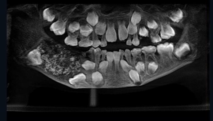 ▲ X 光圖可見男童的下顎處有囊袋。（圖／翻攝自 CNN ）