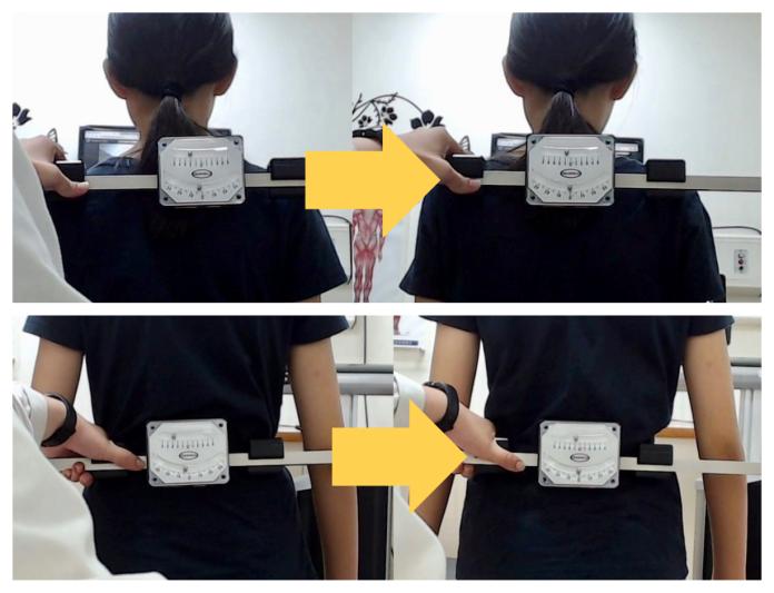 ▲小五生接受KKT聲波動力平衡系統治療短短 1 個月，矯正肩部平衡近 3 度（上）；矯正腰部平衡近 3 度（下）。（合成圖／活力得中山脊椎外科醫院提供）
