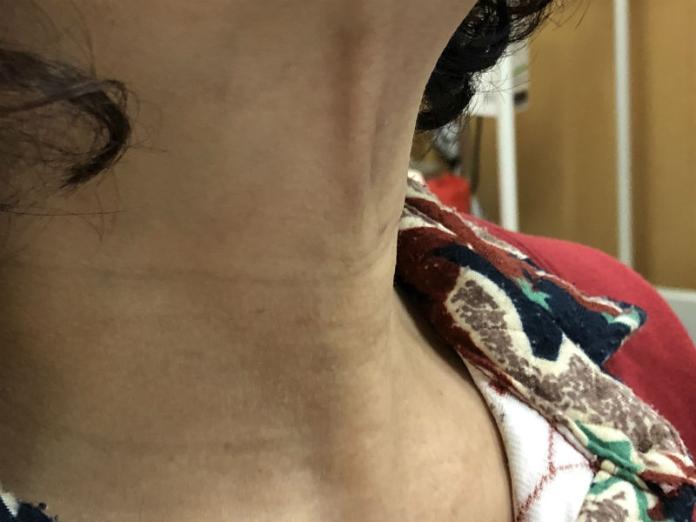 婦人脖子摸到小硬塊患「甲狀腺腫瘤」　經口切除術不留疤
