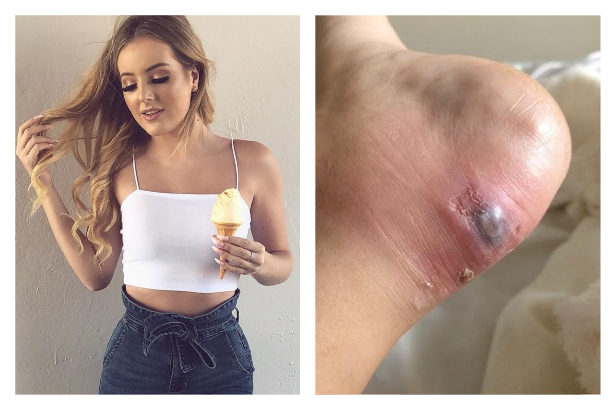 ▲英格蘭的嫩模傑瑪（ Gemma Downey ）因為穿新鞋磨出水泡，竟然差點危及生命。（合成圖／翻攝自 gemmad96 IG）