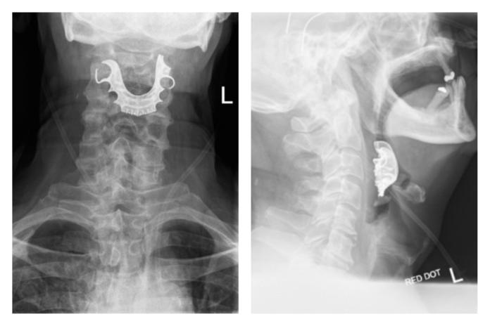 ▲老人的 X 光照片，果然看見喉部卡著「失蹤」的假牙。（合成圖／翻攝自 BMJ Case Reports 網站）