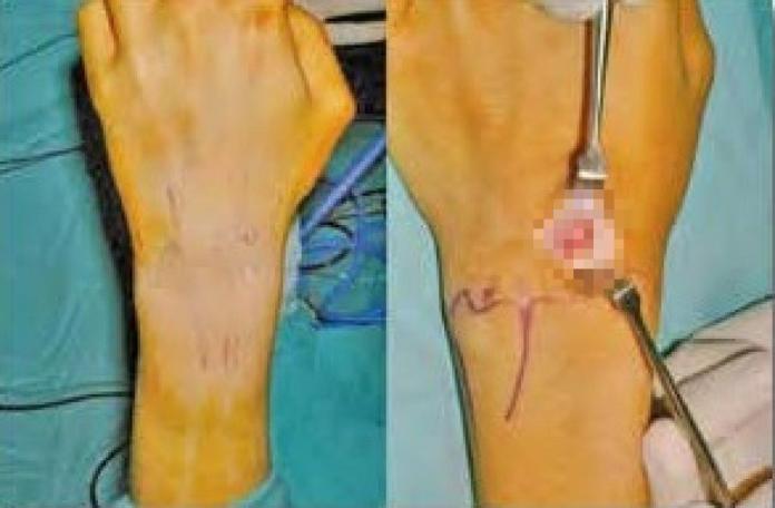 ▲腕關節鏡微創手術傷口為手腕背側 2 個小點（左）與傳統開放手術的傷口（右）比較。 （圖／活力得中山外科醫院骨科朱柏榮主任提供）
