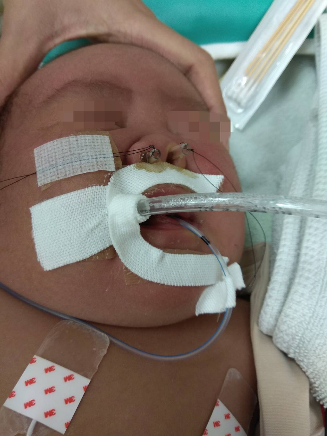 ▲寶妹的鼻孔只有一般新生兒鼻孔的10分之1大，確診為後鼻孔嚴重狹窄。（圖/門諾醫院提供）