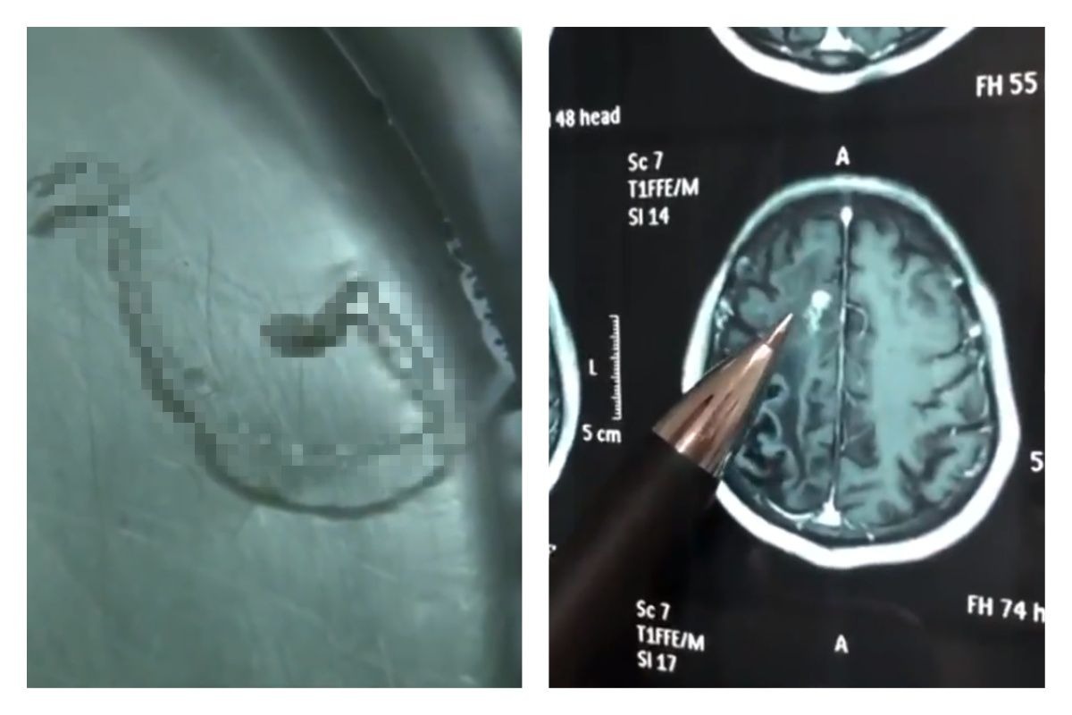 ▲男子半邊身體抽搐、頭痛 30 年，起初診斷為癲癇，後來才發現是遭寄生蟲感染。（合成圖／翻攝自梨視頻）
