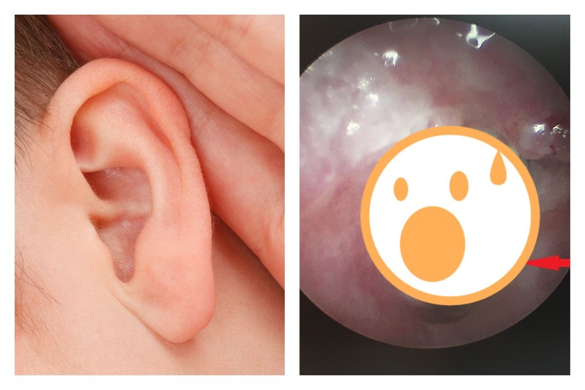 ▲男子右耳聽不見，就醫發現竟然是感染菜花導致！（合成圖／取自 Pixabay 、南投醫院提供）