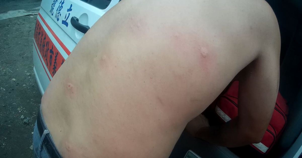 遭虎頭蜂螫傷多處男性，全身刺痛不已。〔圖／嘉市府提供2019.08.22〕