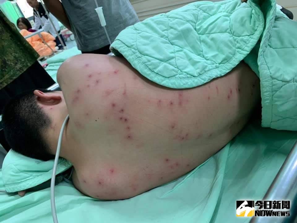 ▲男學生全身被螫百餘處傷口。（圖／記者陳雅芳翻攝，2019.09.01）