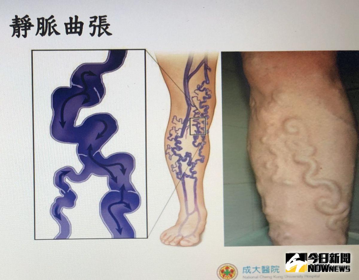 ▲靜脈曲張-浮腳筋，發生急性靜脈血栓可能致命。（圖／記者蘇榮泉翻攝，2019.09.03）