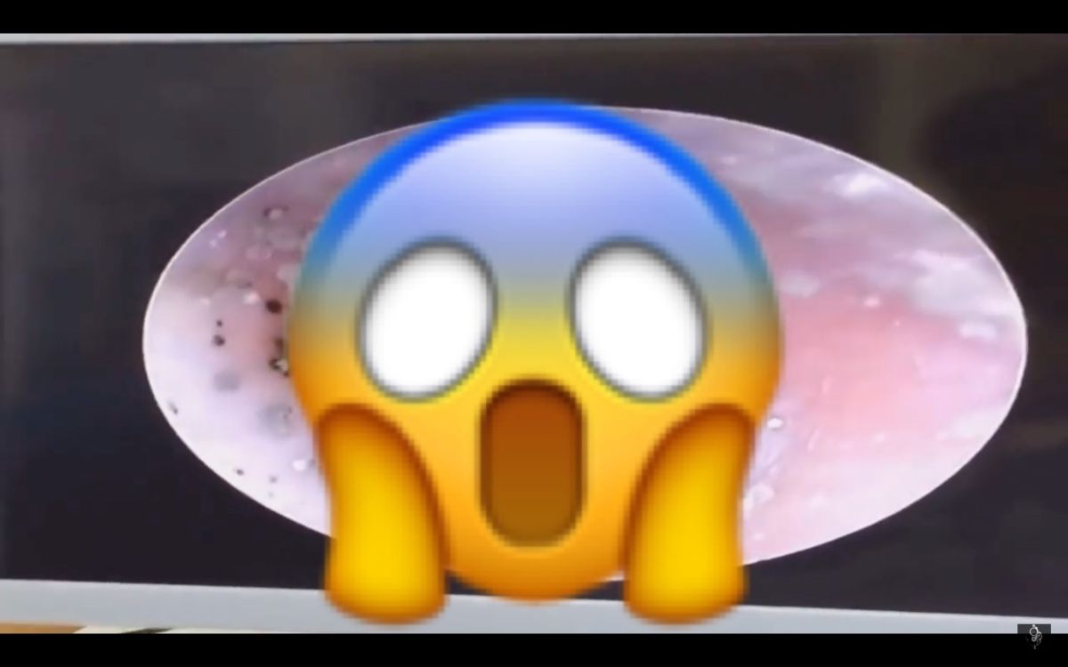 ▲現代人常常會挖耳朵或擠痘痘，甚至更厲害的可以自己擠出黑頭粉刺，但若清得太乾淨的話，可能就會有意想不到的事情發生。（圖／翻攝自影片）