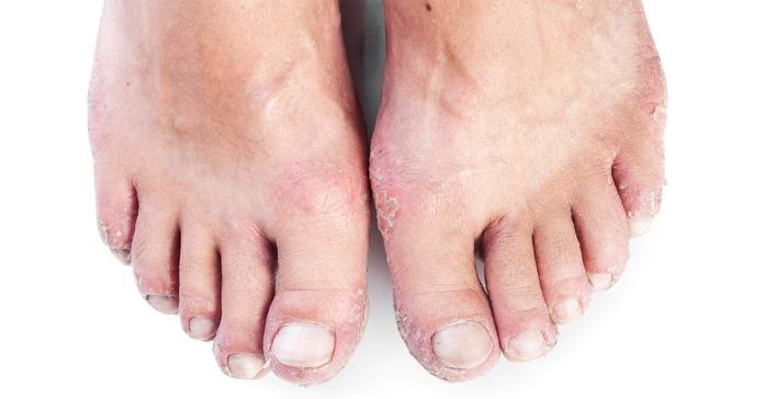 ▲ 乾癬又稱為「牛皮癬」或「銀屑病」，在台灣乾癬的盛行率約0.2%至0.3%，患者在頭皮、臉部、身體和四肢等部位的皮膚，會出現銀白色脫屑和紅色斑塊。（圖／ingimage）