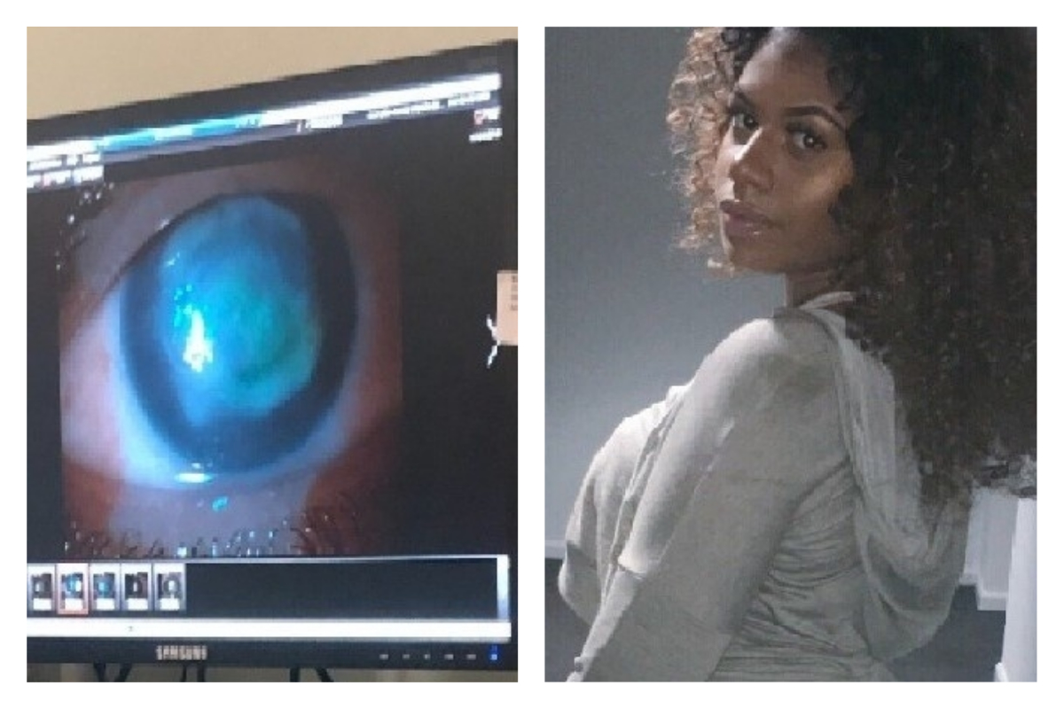 ▲女大生因為戴隱形眼鏡玩水受感染，恐永久性失明。（合成圖／翻攝自 gofundme ）