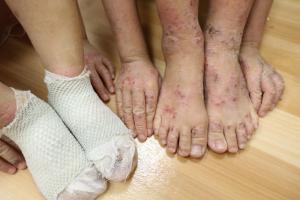 7歲男童和4歲女童罹患異位性皮膚炎，因皮膚搔癢抓到破皮，甚至包上紗布，後經藥物、飲食、環境改善調理，病情已獲得控制。（台中慈濟醫院提供）中央社記者趙麗妍傳真108年9月4日