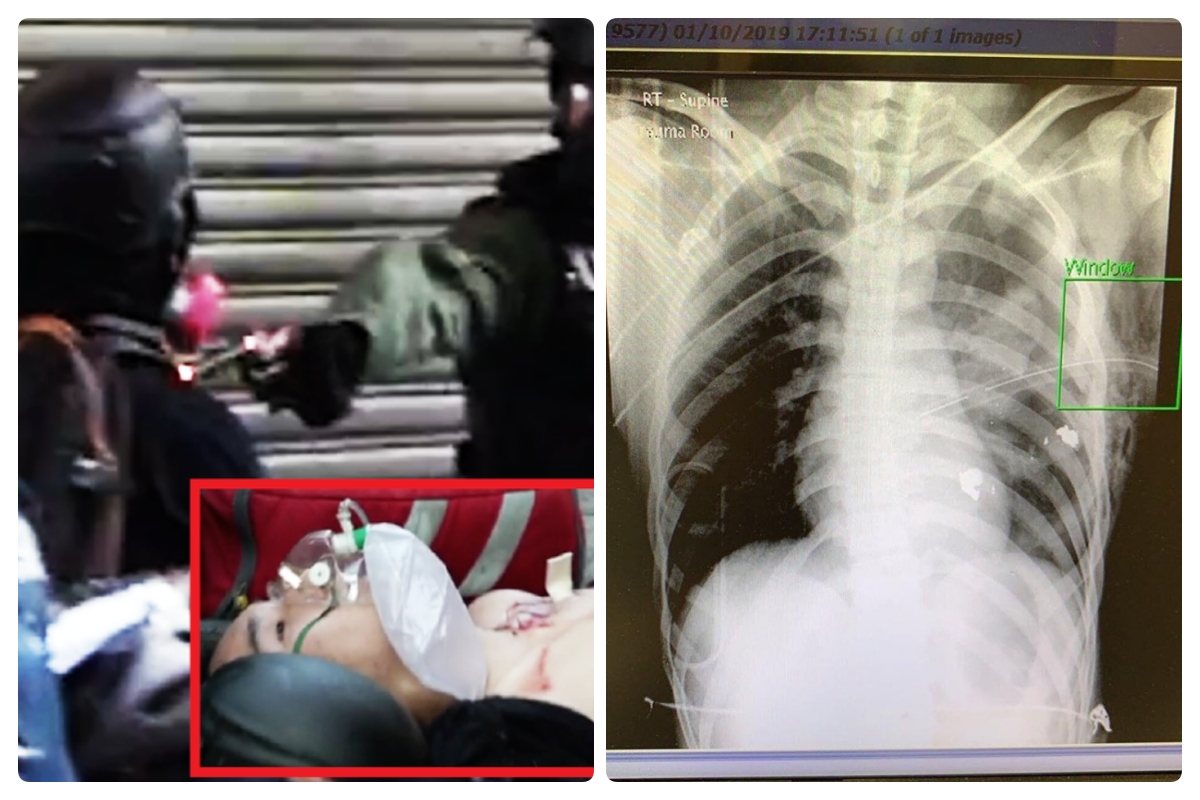 遭港警實彈擊中的高中生，左肺中槍導致氣胸，子彈碎片距離心臟只有3公分。（圖／擷取自TG＿寶寶Channel）