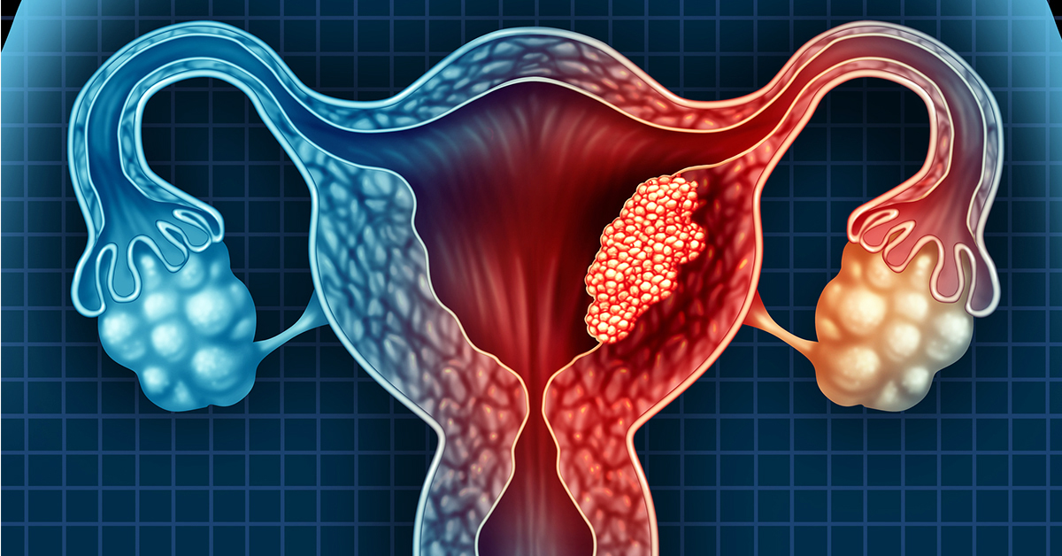 ▲卵巢癌、子宮頸癌、子宮內膜癌等疾病又合稱婦癌，已成為國內外女性的頭號健康殺手，每年罹癌的婦女數量逐漸攀升。（圖／ingimage）