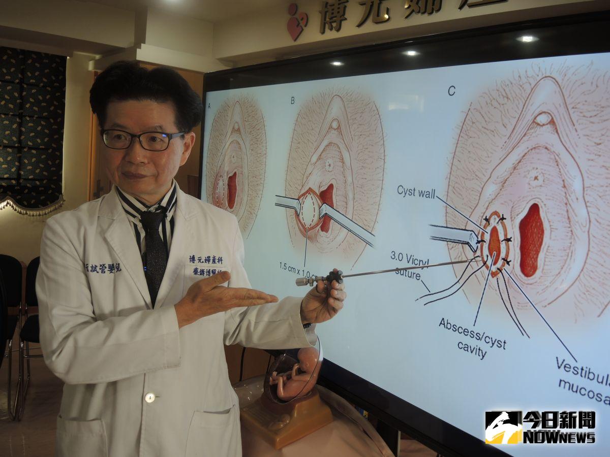 ▲罹患巴氏腺囊腫，透過雷射刀採造袋術，可讓巴氏腺囊腫不再纏身。（圖／記者陳雅芳攝，2019.10.03）