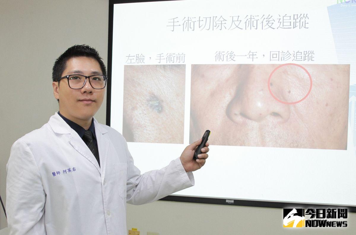 ▲皮膚科何英右醫師說明基底細胞癌是皮膚癌中發生率最高的癌症。（圖／記者蘇榮泉攝，2019.10.08）