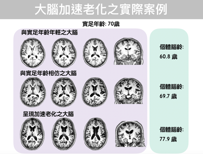 亞洲第1！　陽明大學研究透視大腦年齡預測病變