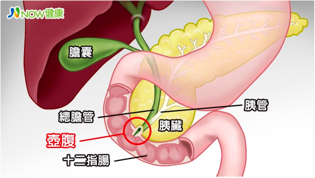 ▲由於壺腹位處膽管及胰管交會的重要部位，鄰近連結許多組織，如果此處冒出腫瘤，特別是惡性癌時，很難斷定是原發的壺腹腫瘤。（圖／NOW健康製作）