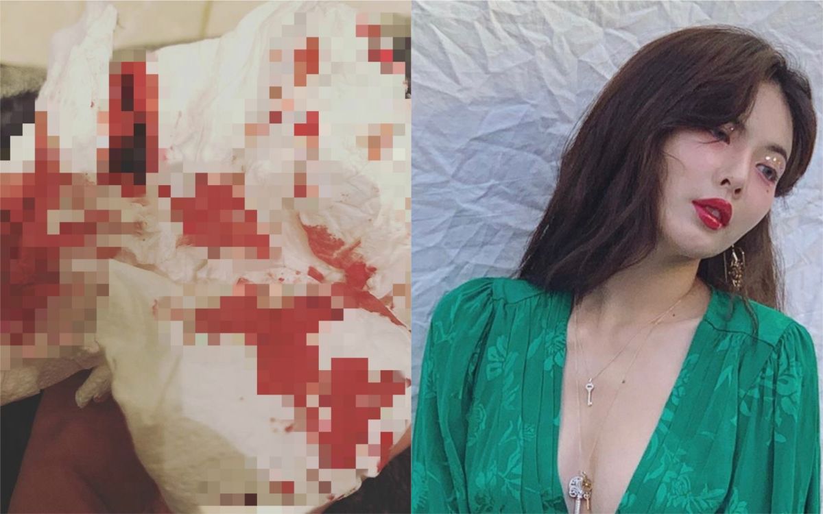 ▲炫雅流滿身鼻血。（圖／翻攝IG）