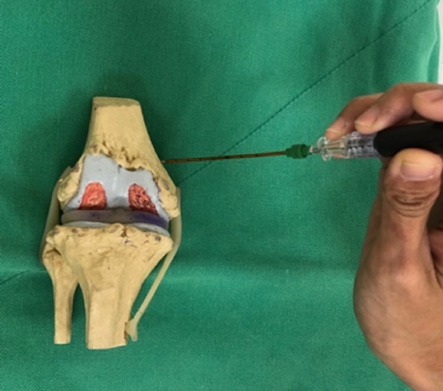 ▲醫師採用冷凝式高頻熱凝術，針對退化性膝關節炎治療痛覺神經。（圖／台大醫院竹東分院提供）